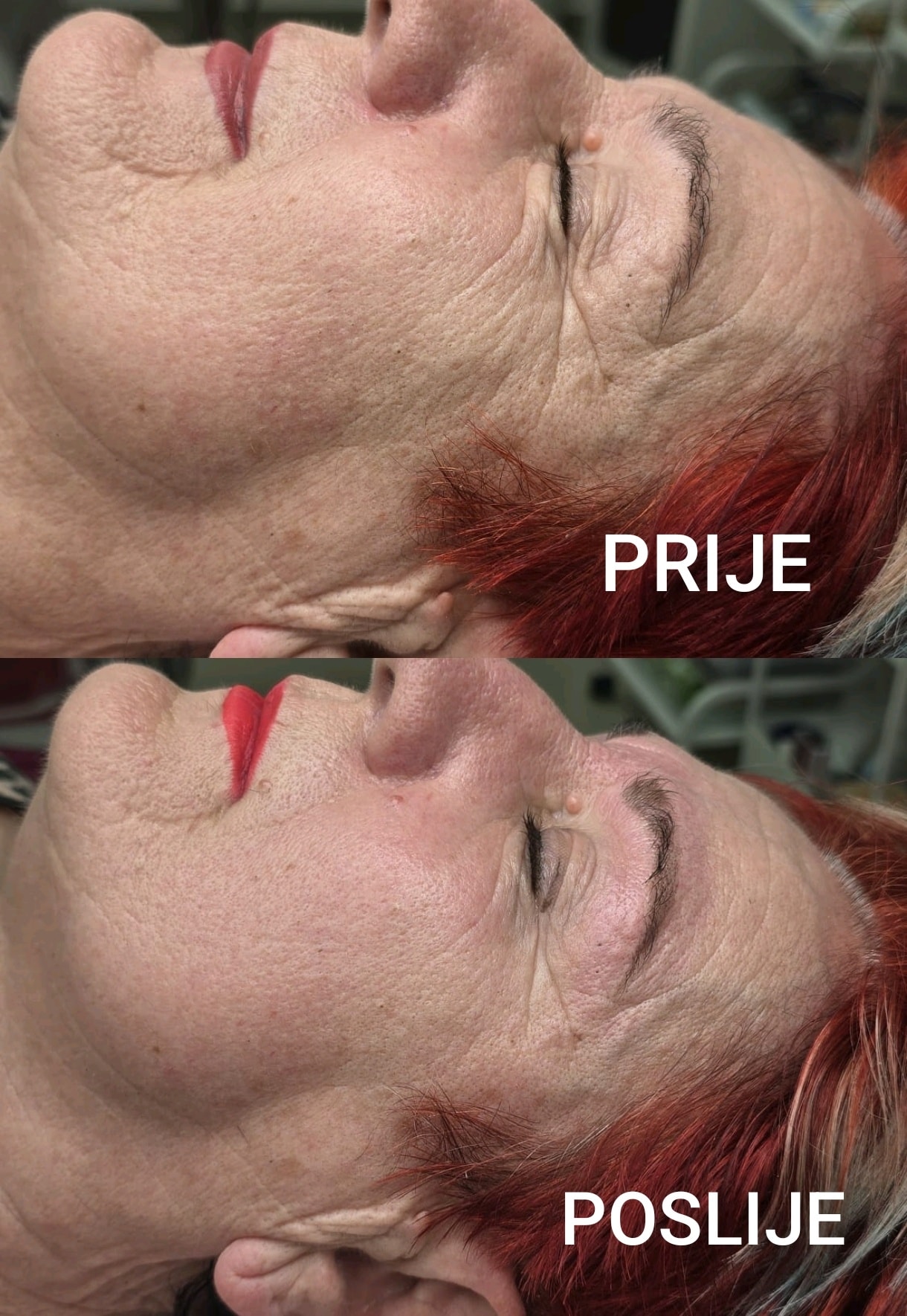 Microneedling i dermaroller